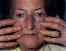 ریجستری اسکلرودرمی